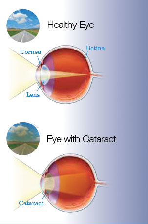 cataract1